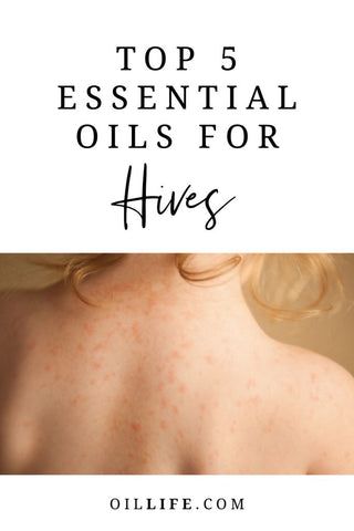 The Top 5 Best Essential Oils For Hives - Oil Life Essential Oils For Rash, Essential Oil For Hives, Natural Remedies For Hives, Hives Remedies, Essential Oils For Congestion, Esential Oils, Diy Essential Oil Recipes, Essential Oils Guide, Essential Oil Spray