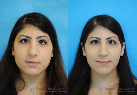 This 3 month before and after revision rhinoplasty result shows a subtle but softer and more feminine nose. Wide Bridge Nose Rhinoplasty, Bulbous Tip Rhinoplasty Before After, Revision Rhinoplasty Before After, Droopy Tip Nose Rhinoplasty, Rhinoplasty Bulbous Tip, Nose Surgery, Surgery, Human