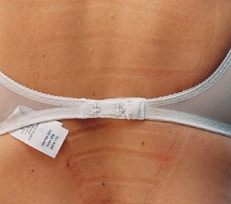 Skin Marks, Petra Collins, Adhesive Bra, Total Body, Pretty Little Liars, Art Exhibition, Body Positivity, Life Style, The Back