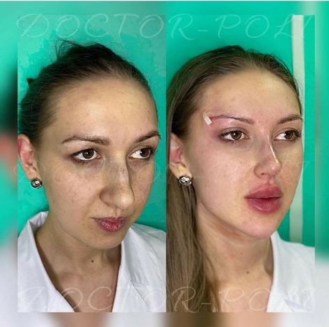 Face Contouring Fillers, Eye Lift Surgery, Nose Surgery Rhinoplasty, Plastic Surgery Fail, Rhinoplasty Nose Jobs, Face Surgery, Plastic Surgery Gone Wrong, Facial Surgery, Perfect Nose