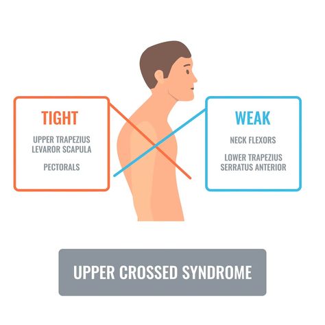 Upper Crossed Syndrome (UCS) is a posture-related condition often seen in individuals who spend a lot of time sitting or engaging in activities that promote poor posture. It's characterized by an imbalance in the neck, Upper Cross Syndrome Exercises, Upper Cross Syndrome, Posture Correction Exercises, Neck Ache, Neck Hurts, Muscles Of The Neck, Forward Head Posture, Neck Exercises, Reduce Tension