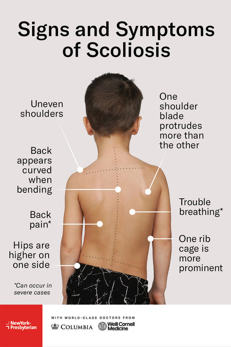 #Scoliosis is a treatable condition characterized by an abnormal curvature of the spine that is often detected between the ages of 10 and 15. Dr. Michael Vitale, Chief of Pediatric Spine Surgery with #OchSpine at #NYPMorganStanley, explains the importance of early diagnosis and shares the signs to look out for. Tap the link to learn more this #ScoliosisAwarenessMonth. Spine Curvature, Spine Care, Cervical Spondylosis, Healthy Spine, Medical Photography, Spine Surgery, Human Species, Signs And Symptoms, The Signs