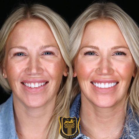 Cosmetic Dentist Houston TX | Dental Implants Sugar Land | Veneers TX Veneers Before And After, Teeth Transformation, Dental Esthetics, Virtual Consultation, Dental Cavities, Perfect Teeth, Teeth Implants, Dental Veneers, Nice Teeth