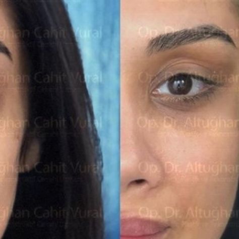 Cat Eye Surgery. It is a popular plastic surgery recently. Cat Eye Surgery Photos by Dr. Altuğhan Cahit Vural. For detailed information please write us info@cahitvural.com Cat Eye Surgery, Facial Surgery, Brow Lift, Eye Surgery, After Surgery, Skin Products, Cat Eyes, Anti Aging Skin Products, Plastic Surgery