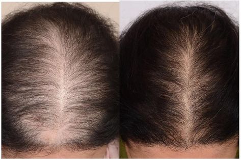 Diffuse Hair, Hair Growth Rate, Prp Hair, Hair Growth Women, Rapid Hair Growth, Cosmetic Injectables, Hair Specialist, Hair Therapy, Female Hair