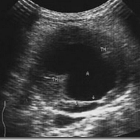 Intussusception ~ Ultrasound Cases Info Uterus Ultrasound, Obstetric Ultrasound, Abdominal Aorta, Medical Sonography, Diagnostic Medical Sonography, Ultrasound Pictures, Ct Scan, Abdominal Pain, Ultrasound