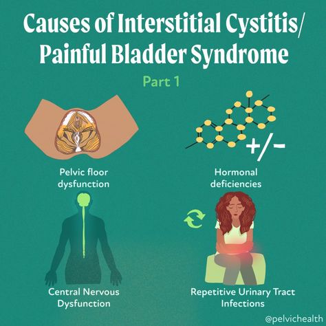 Causes of Interstitial Cystitis/Painful Bladder Syndrome Painful Bladder Syndrome Diet, Yoga For Bladder Control, Bladder Irritants Food, Intercystial Bladder, Intersistial Bladder, Pessary For Bladder Prolapse, Pelvic Pain Relief, Painful Bladder Syndrome, Bladder Health