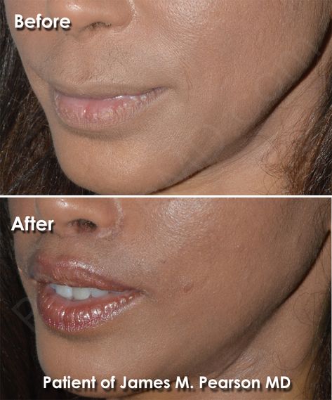 Lip Lift Before And After, Lip Lift Surgery, Lip Flip, Lip Surgery, Lip Lift, Nose Jobs, Rhinoplasty Nose Jobs, Facial Plastic Surgery, Lower Lip