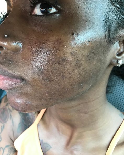 I used to suffer from hormonal & cystic acne. From around 2007-2019 I was going back & forth to the dermatologist. It was hell. My skin got worst & worst. The scarring, the dark spots, the texture, the enlarged pores & inflammation put me in a terrible mental health crisis at times. I was caking on makeup & picking my skin every single day. I went & got shots at the derm for the under the skin cysts several times a month. I spent 1,000s of dollars...I even tried #accutane but I relapsed. It g... Acne Pit Scars, Hormonal Cystic Acne, Big Zits, Blackheads On Cheeks, Pimples On Scalp, Bad Skin, Bad Acne, Skin Aesthetics, Bleaching Cream