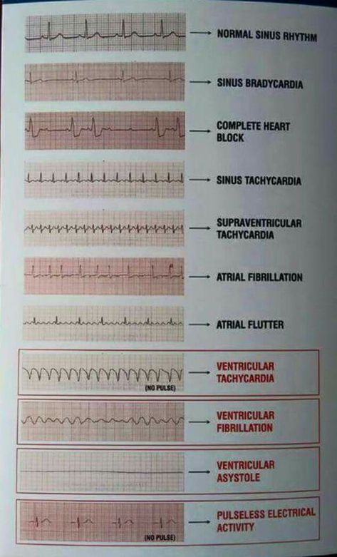 Tele Strip EKG readings                                                                                                                                                                                 More Nursing Cheat, Nursing Mnemonics, Cardiac Nursing, Nursing School Survival, Critical Care Nursing, Nursing School Studying, Nursing School Tips, Nursing School Notes, Medical School Studying