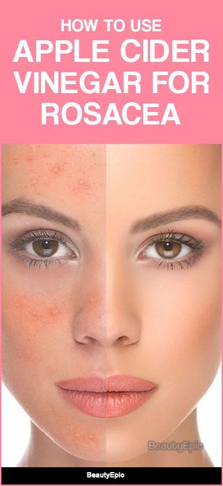 How to Use Apple Cider Vinegar to Treat Rosacea? Red Face Remedies, Redness Remedy, Redness On Face, Natural Disinfectant, Skin Natural Remedies, Saggy Skin, Cider Vinegar, Face Skin, Apple Cider Vinegar