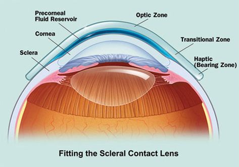 Our #scleral #lenses are #highly #permeable #oxygen and provide #comfort a #soft #lens& #higher #optical #quality Human Anatomy Reference, Soft Contact Lenses, Soft Lens, Art Optical, Contact Lens, Dry Eyes, Anatomy Reference, Human Anatomy, Contact Lenses