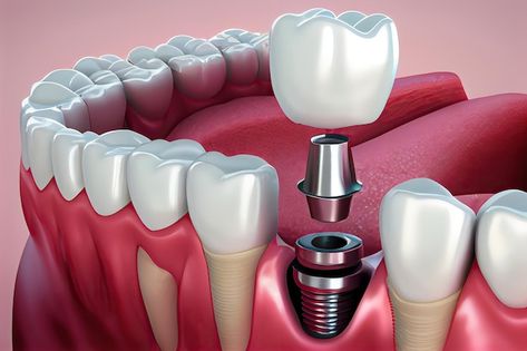 Dental Implant Poster, Dental Implants Advertising, Medical Ads, Illustration Anatomy, Full Arch Dental Implants, Dental Animation, Dental Pictures, Dental Composite, Luxury Cruise Ship