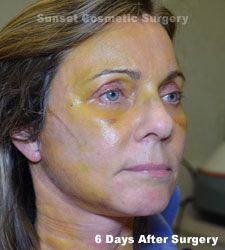 Facelift Recovery Photos Facelift Recovery Day By Day, Facelift Recovery, Lower Face Lift, Neck Lift Surgery, Face Lift Surgery, Fat Grafting, Fat Transfer, Upper Eyelid, Neck Lift