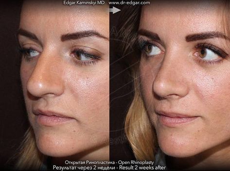 Bulbous Nose Before And After Nose Surgery (1) » Rhinoplasty: Cost, Pics, Reviews, Q&A Bulbous Nose Rhinoplasty Before After, Nose Job Before And After, Bulbous Nose Rhinoplasty, Kpop Plastic Surgery, Nose Rhinoplasty, Jaw Reduction Surgery, V Line Surgery, Bulbous Nose, Plastic Surgery Fail