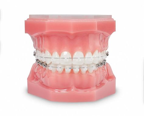 Clear Braces Ceramics, Braces Aesthetic, Damon Braces, Fixed Braces, Ceramic Braces, Types Of Braces, Clear Braces, Braces Colors, Tooth Removal