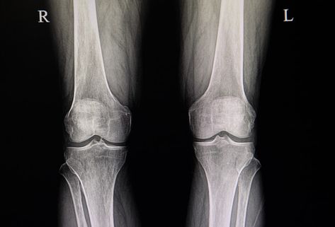 Osteoarthitis of both knees | Premium Photo #Freepik #photo Knee Xray, Xray Images, X-ray Images, Knee Replacement, Premium Photo, Custom Shirts, Medical, Stock Photos, Hair Styles