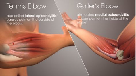 Elbow Exercises, Elbow Pain Relief, Ulnar Nerve, Pain Relief Gel, Golfers Elbow, Forearm Muscles, Elbow Braces, Elbow Pain, Tennis Elbow