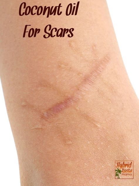 Scar got your down? Learn more about coconut oil for scarring as well as tons of other natural remedies that can reduce the appearance of scarring. Brought to you by HybridRastaMama.com. Sagging Skin Remedies, Scar Remedies, Cystic Acne Remedies, Oils For Scars, Natural Acne Remedies, Natural Acne, Scar Removal, Scarring, Acne Remedies