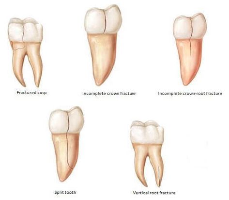 Music Manager, Tooth Extraction Healing, Teeth Images, Amalgam Fillings, Dentistry Office, Cracked Tooth, Chipped Tooth, Dental Bonding, Teeth Grinding