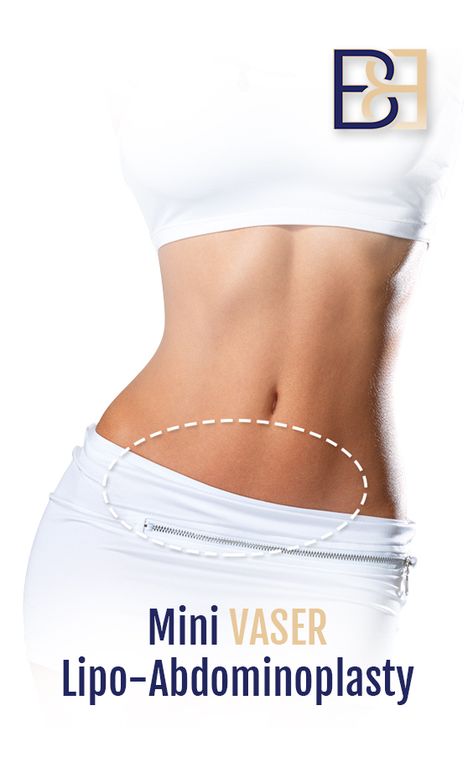 Mini VASER lipo-abdominoplasty offers an effective solution to correct loose skin in the lower abdomen. Ideal candidates for this procedure are primarily women who’ve had children and have a small amount of overhang in the lower abdomen. Patients for this procedure generally have NO or only a minimal amount of muscle separation. This procedure is commonly performed on women who’ve had a C-section and suffer from skin hanging over the C-section scar.  *Individual results vary. Surgery has risk Stomach Lipo Before And After, Lipo Recovery, Exercise After C Section Lose Belly, Lipo 360 Post Op Care, Lipo Before And After, Vaser Lipo Before And After Abdomen, Vaser Lipo, Muscle Separation, C Section Scars