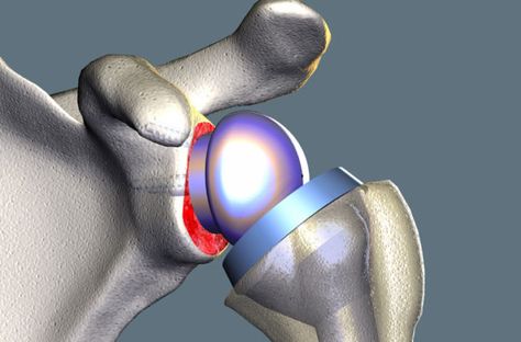 Facing Shoulder Surgery? Is Joint Replacement or Fusion Best for You? – Health Essentials from Cleveland Clinic Reverse Shoulder Replacement, Sinus Massage, Shoulder Replacement Surgery, Rotator Cuff Tear, Neck Problems, Shoulder Surgery, Knee Surgery, Knee Replacement, Rotator Cuff