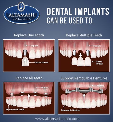 Dental Nursing, Dental Post, Dental Wallpaper, Dental Assistant Study, Dental Advertising, Dental Materials, Dental Images, Dental Jewelry, Dental Posts