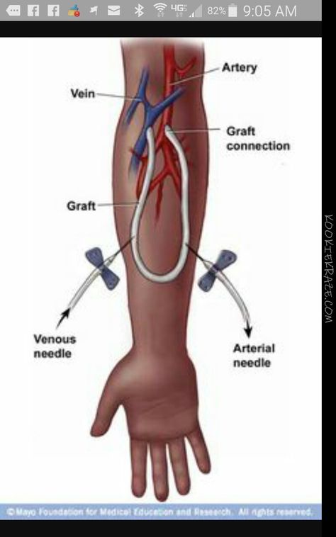 AV graft Patient Care Tech, Patient Care Technician, Vascular Ultrasound, Kidney Pain, Interventional Radiology, Kidney Function, Nursing School Survival, Group Picture, Nursing School Tips