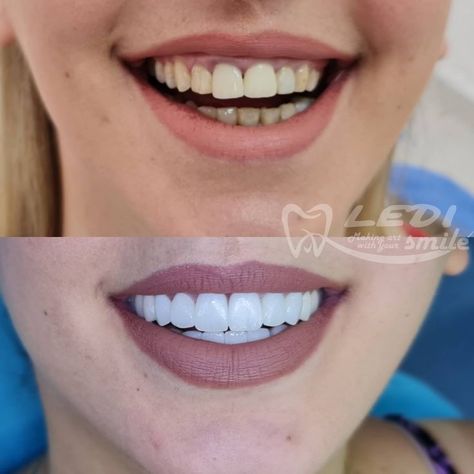 Hollywood Smile, Attitude Bio For Instagram, Beautiful Teeth, Perfect Teeth, Dental Art, Teeth Care, Cat Drawing, Beautiful Smile, Plastic Surgery