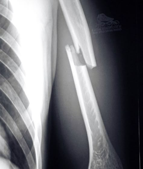 Fractured Humerus / Recovery Time is about 9 to 16 weeks depending on severity – #arm #upperarm #fracture #humerus #xray #inlinespeedskating #injury #bones #broken Organic Mechanic, Blue Healer, Radiologic Technology, Skull Animal, Xray Art, Arm Bones, Brindle Boxer, Cat Scan, Skull Reference