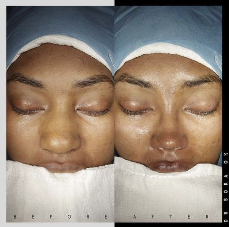 Nose Job Before And After Black, Nose Jobs Black Women, Black Nose Job, Ethnic Rhinoplasty African Americans, Black Rhinoplasty, Nose Job Black Women, Perfect Nose Rhinoplasty, Nose Job Before And After, Nose Job Inspo