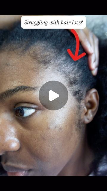 Your Hair Growth Guide 👸🏾 | 🚨 Struggling with Hair Issues? These Herbs Could Be the ANSWER! 🌱

Whether it’s hair loss, shedding, or damaged follicles, there’s a... | Instagram Treating Dandruff, Prevent Dandruff, Hair Issues, Hair Shedding, Hair Remedies, Beauty Industry, Dandruff, Ayurveda, For Hair