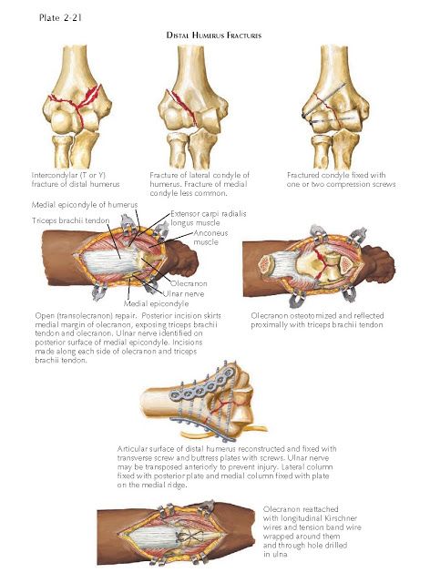 Triceps Brachii Muscle, Humerus Fracture, Cancellous Bone, Ulnar Nerve, Skill Saw, Musculoskeletal System, Orthopedic Surgery, Ct Scan, After Surgery