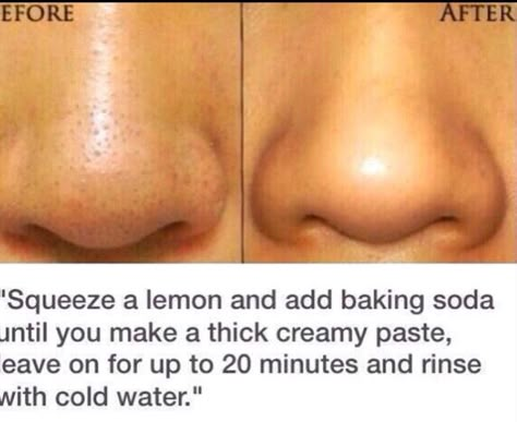 Health tips Jus Lemon, Blackhead Remedies, Black Heads, Get Rid Of Blackheads, Skin Pores, Beauty Remedies, Acne Remedies, Beauty Tricks, Homemade Beauty Products