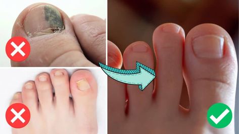 How to Treat Ingrown Toenails at Home How To Treat Ingrown Toenail, Ingrown Toenail Remedy, Apple Cider Vinegar Foot Soak, Ingrown Toenail, Ingrown Nail, Geometric Nail Art, Foot Injury, Under The Skin, Geometric Nail