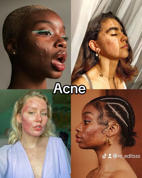 Beautiful insecurities🪷 Natural Makeup Acne, Acne Girls Pretty, Bad Acne Pictures, Makeup With Acne Skin, Models With Acne, Drawing Acne, Acne Black Women, Girls With Acne, Makeup With Acne