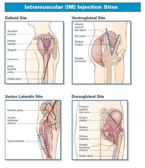 Intramuscular (IM) Administration Im Injection Sites, Med Surge, Im Injection, Injection Sites, Nursing Knowledge, Pharmacology Studying, Medical Assisting, Nurse Things, Nursing Cheat