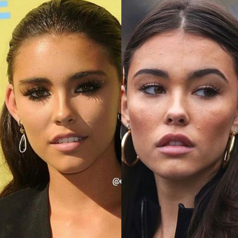 Madison Beer before plastic surgery Fox Eye Lift Before And After, Madison Beer Eyebrows, Foxy Eye Surgery, Nose Lift, Megan Fox Lips Injections, Surgery Nose, Eye Lift Surgery, Megan Fox Surgery, Fox Eye Lift Surgery