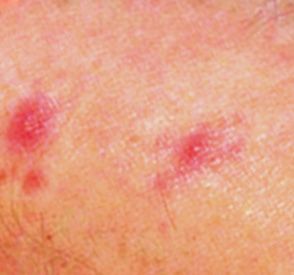 Identify Bug Bites - Common Bug Bites | Orkin Bug Bite Identification Chart, Insect Bites Identification, Bug Bites Identifying Chart, Infected Bug Bite, Bug Bites Identifying, Red Bug Bites, Tick Bites Pictures, Bed Bug Bites Pictures, Dust Mites Bites