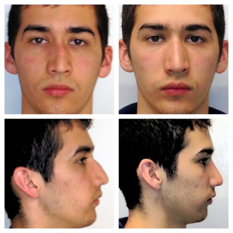 Rhinoplasty for crooked nose, breath better and look better. Crooked Nose Front View, Broken Nose Reference, Crooked Nose Men, Nose Upward Angle, Hooked Nose Side Profile Male, Upturned Nose With Bump, Crooked Nose, Hooked Nose, Grey Smokey Eye