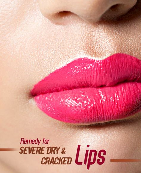 Severe dry and cracked lips can be an uncomfortable and frustrating condition that affects many people. Whether it's due to harsh weather conditions, dehydration, or certain habits, such as excessive licking of the lips, finding an effective remedy is essential to restore moisture and promote healing. In this comprehensive guide, we will explore various remedies for severe dry and cracked lips that you can incorporate into your daily routine to achieve soft, smooth, and hydrated lips. Chiropractic Therapy, Lip Sunscreen, Dry Cracked Lips, Hydrated Lips, Medical Consultation, Rogue Fitness, Musculoskeletal System, Cracked Lips, Chiropractic Care