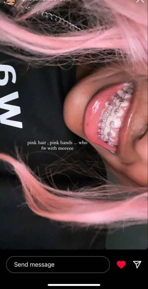 Braces Aethstetic, Pink Braces Black Women, Braces Colours For Brown Skin, Dark Pink Braces, Cute Braces Colors For Brown Skin, Cute Braces Colors For Light Skin, Pink Braces Aesthetic, Light Pink Braces, Braces Colors Ideas Dark Skin