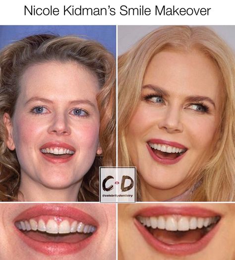 Celebrity 👄 Dentistry’s Instagram profile post: “NICOLE KIDMAN’S SMILE MAKEOVER 😁📝Veneers and a gum lift make the smile look more symmetrical and less collapsed here. #veneers #smile…” Pretty Teeth Smile, Celebrity Veneers, Gum Lift, Teeth Makeover, Cheek Implants, Pretty Teeth, Plastic Surgery Photos, Dental Decay, Botox Lips