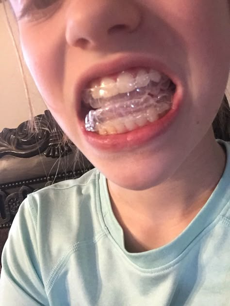 Getting Braces Off, Getting Your Braces Off, After Braces, Adult Braces, Getting Braces, Braces Off, Braces Girls, Orthodontic Appliances, Dental Problems