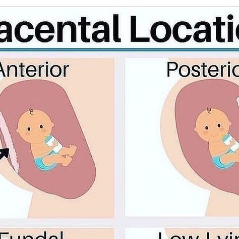 Pregnancy | Moms | Postpartum on Instagram: "Anterior Placenta: When the placenta is attached to the front side of vour uterus - between your baby and the front of your belly. This can typically result in feeling less fetal movement early on in your pregnancy, but is otherwise harmless. Posterior Placenta: Where your placenta attaches to the back of your uterus - closest to your spine. Usually women with posterior placenta feel fetal movement earlier in the pregnancy. Fundal Placenta: When your placenta attaches to the top of your uterus. There are two different types - fundal-anterior placenta where it extends to the front of the uterus and fundal-posterior where it extends towards the back of your uterus. Low-Lying or Placenta Previa: This is broken down into 3 categories - Complete (it Anterior Placenta Gender Prediction, Low Lying Placenta, Anterior Placenta, Fetal Movement, First Ultrasound, Gender Prediction, Pregnancy Guide, Maternal Health, Pregnancy Health