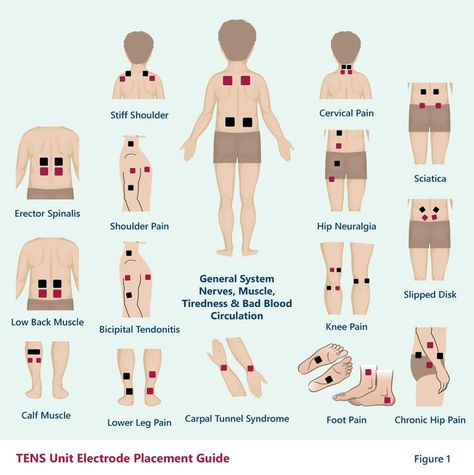 Tens Electrode Placement, Tens Unit Placement, Lower Leg Pain, Cervical Pain, Tens Machine, Tens Unit, Muscle Knots, Tens Ems, Ten Unit