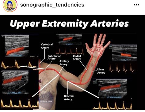 Vascular Ultrasound Anatomy, Diagnostic Medical Sonography Student, Ultrasound School, Arteries Anatomy, Medical Radiography, Cardiac Sonography, Digital Radiography, Vascular Ultrasound, Sonography Student