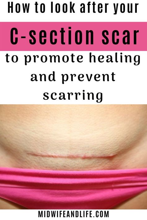 How to look after your c-section scar to promote healing and prevent scarring. C-section, caesarean, cesarean, c-section scar, wound healing, reduce scarring on c-section, looking after your c-section, can I drive after c-section, recovery rate c-section C Section Incision Healing, C Section Scar Healing, C Section Scar Tattoo, Scar Massage, Photoshoot Ideas Maternity, C Section Scar, Birth Hospital, Pregnancy Photoshoot Ideas, C Section Scars