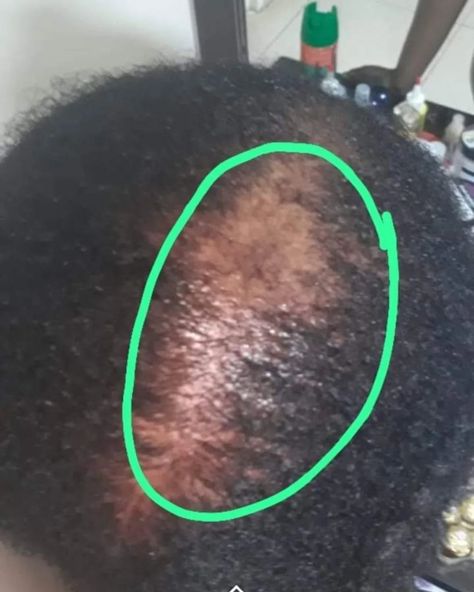 #BEFORE and #AFTER can you see the difference imwe you guys🙆🏽🤭 the #PROCESS of a bald patch is being restored..never give up on your hair goals‼️ trust the process call us on +260 976028144 or visit us at kulima Tower building next to book world #alopeciaawareness #growth #solutions Alopecia Awareness, Bald Patches, Tower Building, Trust The Process, You Gave Up, Never Give Up, Hair Goals, The Process, Tower