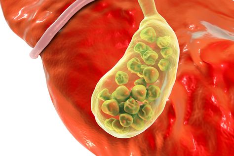 Is It Heartburn or Something Else? Esophageal Spasm, Gallbladder Flush, Gallbladder Cleanse, Gallbladder Surgery, Bile Duct, Stomach Ulcers, Reflux Disease, Stomach Pain, Abdominal Pain